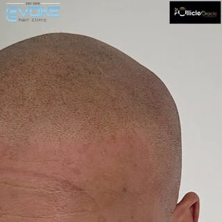 Another amazing SMP transformation, what a difference for our lovely client 🤩. Face framed, years k