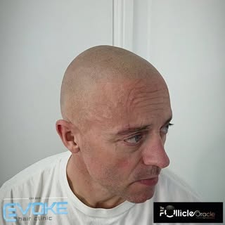 #smp its in the game #scalpmicropigmentation #hairtattoo #hairloss