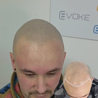 3rd session results soft and natural #scalpmicropigmentation #smp #hairtattoo