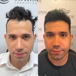 Não é só cabelo. É confiança recuperada.

O antes mostra as falhas. O depois mostra um resultado nat