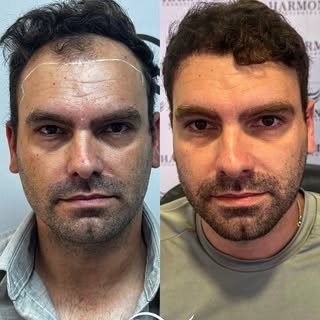 8 meses depois, o resultado fala por si.

O caso do @ericzanivieira mostra que um transplante capila