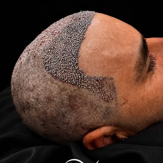 O resultado começa muito antes do cabelo crescer.

Cada ponto implantado representa uma nova oportun