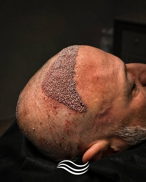 O resultado começa no dia da cirurgia.

Hoje compartilhamos o caso do Nadiel, que passou pelo transp