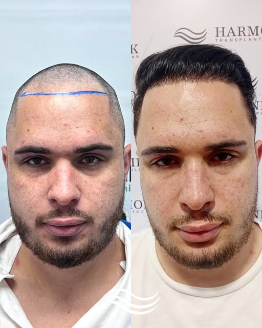 Um novo visual. Uma nova confiança.

O transplante capilar não transforma apenas os fios, ele pode t