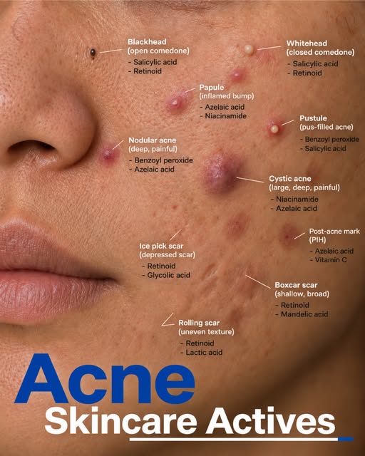 Acne is not one condition with one treatment. Different types of acne respond to different active in