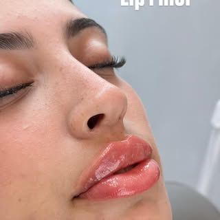 Soft volume. Beautiful definition. Effortless balance. 💋

Lip filler isn’t about creating bigger li