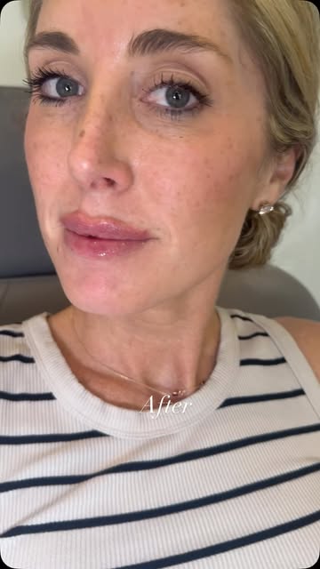 Hydration + definition ✨

A little lip enhancement can go a long way. We focused on restoring hydrat