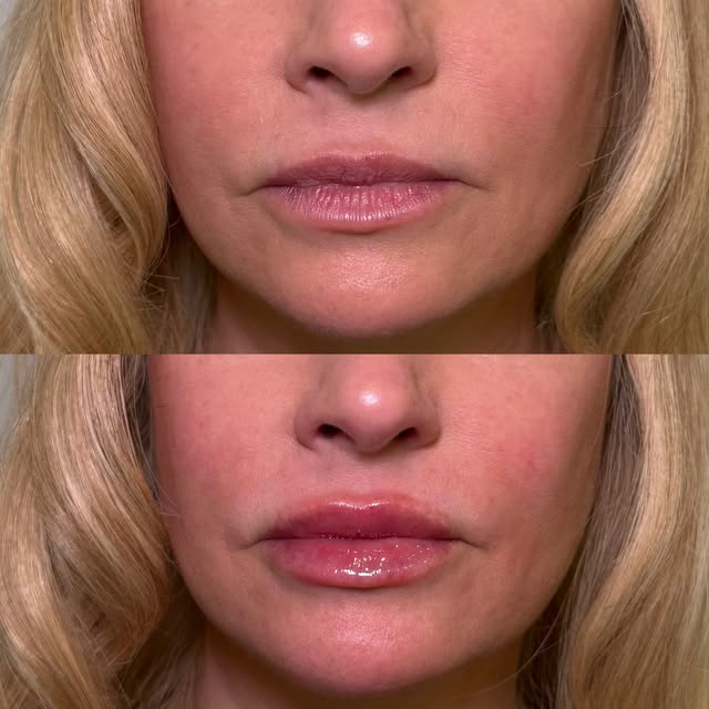 let’s talk swelling post lip filler ❤️‍🔥

directly after injections you’ll see temporary inflammati