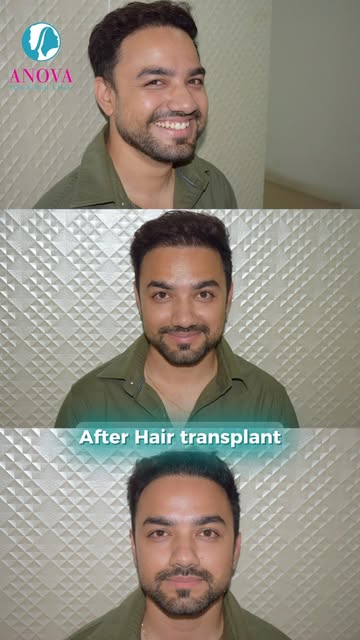 Thank you for the Review Ashish ji. 

For Your Skin/Hair Consultation :
​🔍 Anova Skin & Hair Clinic