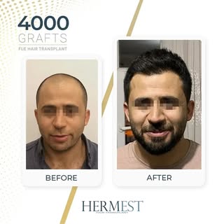 Hair transplant results after 12 months, using the FUE technique.

#FUEHairTransplant #HairTransplan