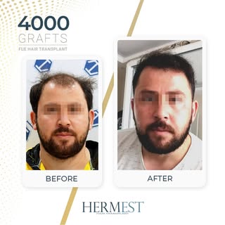 Hair transplant results after 12 months, using the FUE technique.

#FUEHairTransplant #HairTransplan