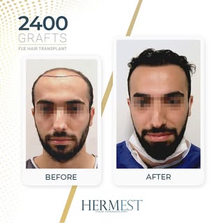 Hair transplant results after 12 months, using the FUE technique.

#FUEHairTransplant #HairTransplan