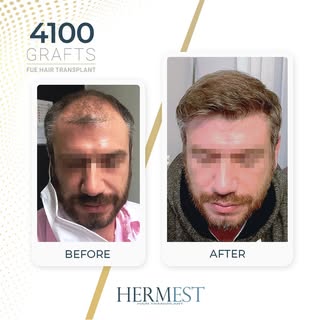 Hair transplant results after 12 months, using the FUE technique.

#FUEHairTransplant #HairTransplan
