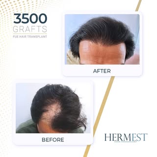 Hair transplant results after 12 months, using the FUE technique.

#FUEHairTransplant #HairTransplan