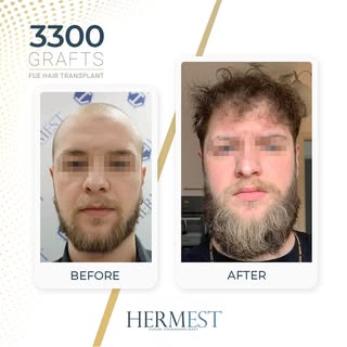 Hair transplant results after 12 months, using the FUE technique.

#FUEHairTransplant #HairTransplan