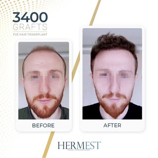 Hair transplant results after 12 months, using the FUE technique.

#FUEHairTransplant #HairTransplan