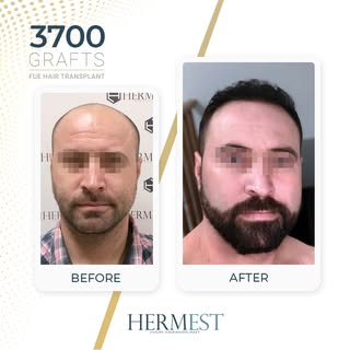 Hair transplant results after 12 months, using the FUE technique.

#FUEHairTransplant #HairTransplan