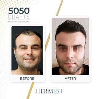 Hair transplant results after 12 months, using the FUE technique.

#FUEHairTransplant #HairTransplan