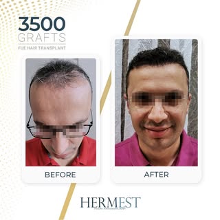 Hair transplant results after 12 months, using the FUE technique.

#FUEHairTransplant #HairTransplan