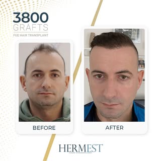 Hair transplant results after 12 months, using the FUE technique.

#FUEHairTransplant #HairTransplan