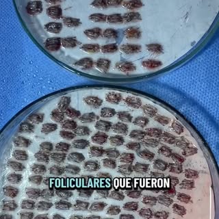 Así se ven las unidades foliculares seleccionadas y preparadas para el trasplante capilar 🧬🔬.
Cada