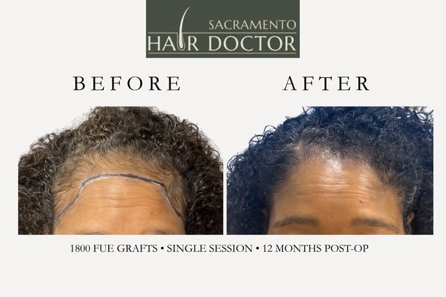 This transformation speaks for itself!✨
This patient wanted to restore thinning along her hairline w