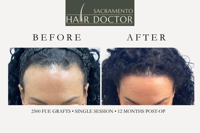 The hairline comeback we love to see! 🔥✨ 

After one FUE hair-restoration session with 2,500 carefu