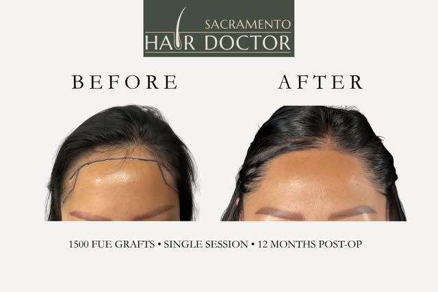 A Beautiful Hairline✨
This patient received 1,500 carefully placed FUE grafts in a single session ab