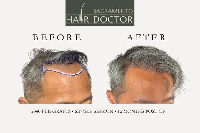 TRUST. THE. PROCESS. 🔥 Just look at this transformation!

With 2,360 carefully placed FUE grafts in