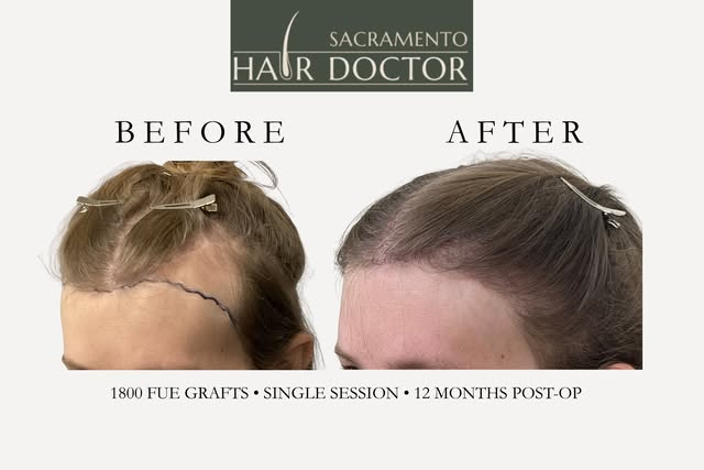 Hair up, hair down, middle part, or ponytail she has ALL the options again. 💁‍♀️

Temporal recessio