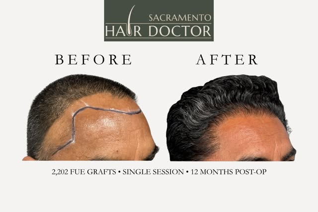 47 and Hitting His Hair-Restoration Goals. 🔥 A fuller hairline, stronger coverage, and natural-look