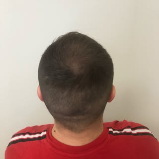 Dein Hinterkopf wird immer lichter 😰😰😰 
Mit einer Haarpigmentierung kannst schon in einem sehr fr