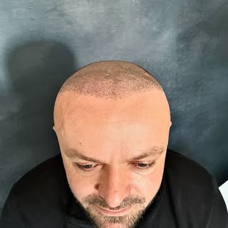 Der Shavelook ist meist die Lösung nach einer misslungenen Haartransplantation ☝🏼☝🏼☝🏼 
Du willst 