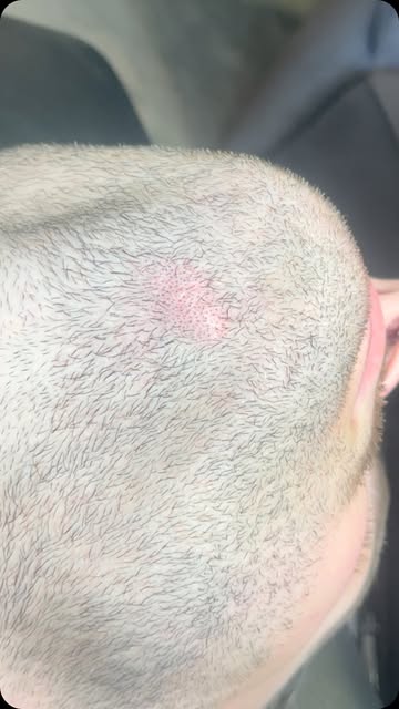 Loch im Bart !?🧔🏻‍♂️ kein Problem, nach einer vergangenen Operation hatte mein Kunden ein Loch in 