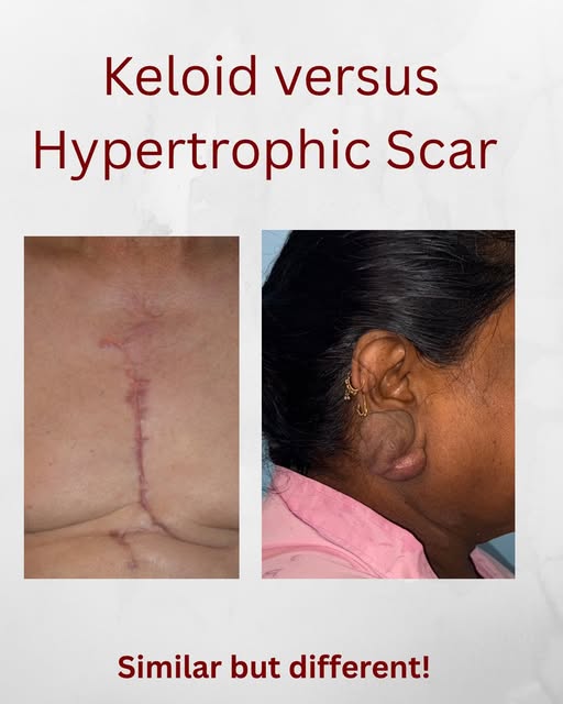 Not every raised scar needs the same treatment. ✨

Scars can change in appearance, texture and behav