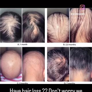 ✨ Confidence Begins with Restoration. ✨

Hair loss may be part of your story, but it does not have t