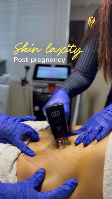 Post-pregnancy abdominal laxity can be treated but the right treatment depends on what has changed 
