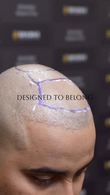 A natural hair transplant is the result of a thousand decisions made right.

The hairline. The donor