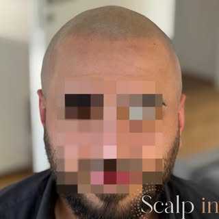 Die neue Haarlinie gibt dem gesamten Kopf wieder Struktur, Symmetrie und einen natürlichen Rahmen. G