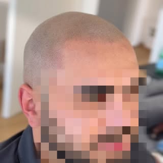 Clean Hairline. Neuer Look. Neues Gefühl. 🔥

Haarpigmentierung kann mehr als nur Haare optisch verd