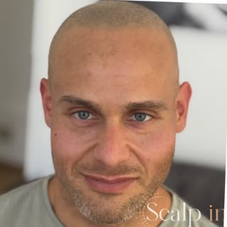 Von der Enttäuschung zur Perfektion.

Alles begann mit einer fehlgeschlagenen Haartransplantation. D