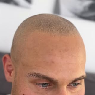 Nicht mehr. Nicht weniger. Einfach Haare.

Du wünschst dir wieder eine natürliche Haarlinie oder opt