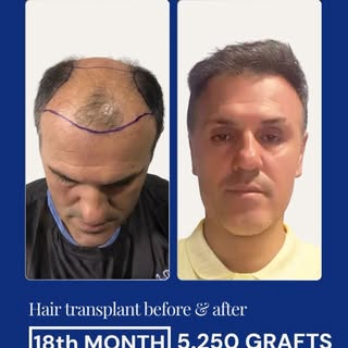 A successful hair transplant is more than just adding new hair — it’s about careful planning, precis