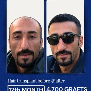 A new look, renewed confidence. 

Hair transplantation is not only about increasing hair density—it 