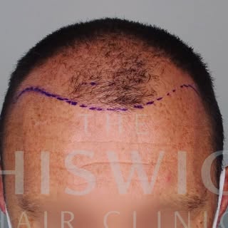 Another example of a case I did recently and the great results that can be achieved through FUE.  #f
