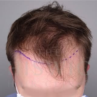 Another great before and after here.  #fue #hairtransplant #chiswickhairclinic #hairclinic #hairrest