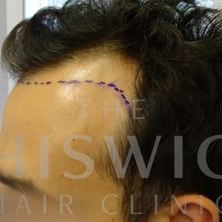 Another great before and after of our FUE procedure. If you are considering doing an FUE procedure, 
