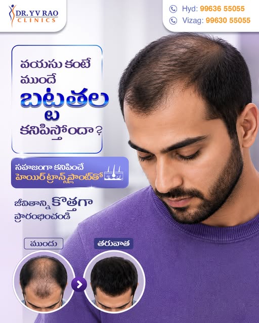 Experiencing hair thinning, a receding hairline, or bald patches? You don’t have to let hair loss af