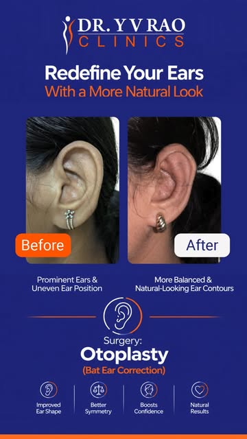 BAT EARS 👂

Do your ears appear more prominent or stick out from the sides of your head?

Otoplasty