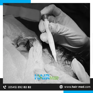 DHI tekniği ile doğal görünüm ve kalıcı sonuçlar 🤩 HairMed her şey dahil hizmet ve 7/24 destek ile 